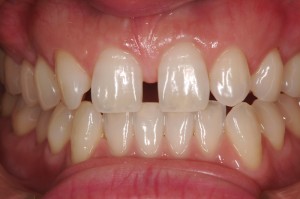 臼歯ダイレクトボンディング　ハンズオン　歯科/自費